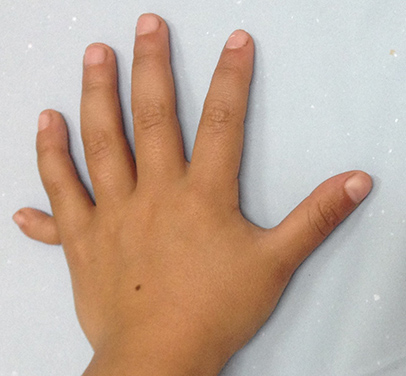 На 1 руке 6 пальцев. Ульнарная полидактилия. Постатаксиальная полидактилия. Полидактилия мизинца руки. Постаксиальная полидактилия левой кисти.